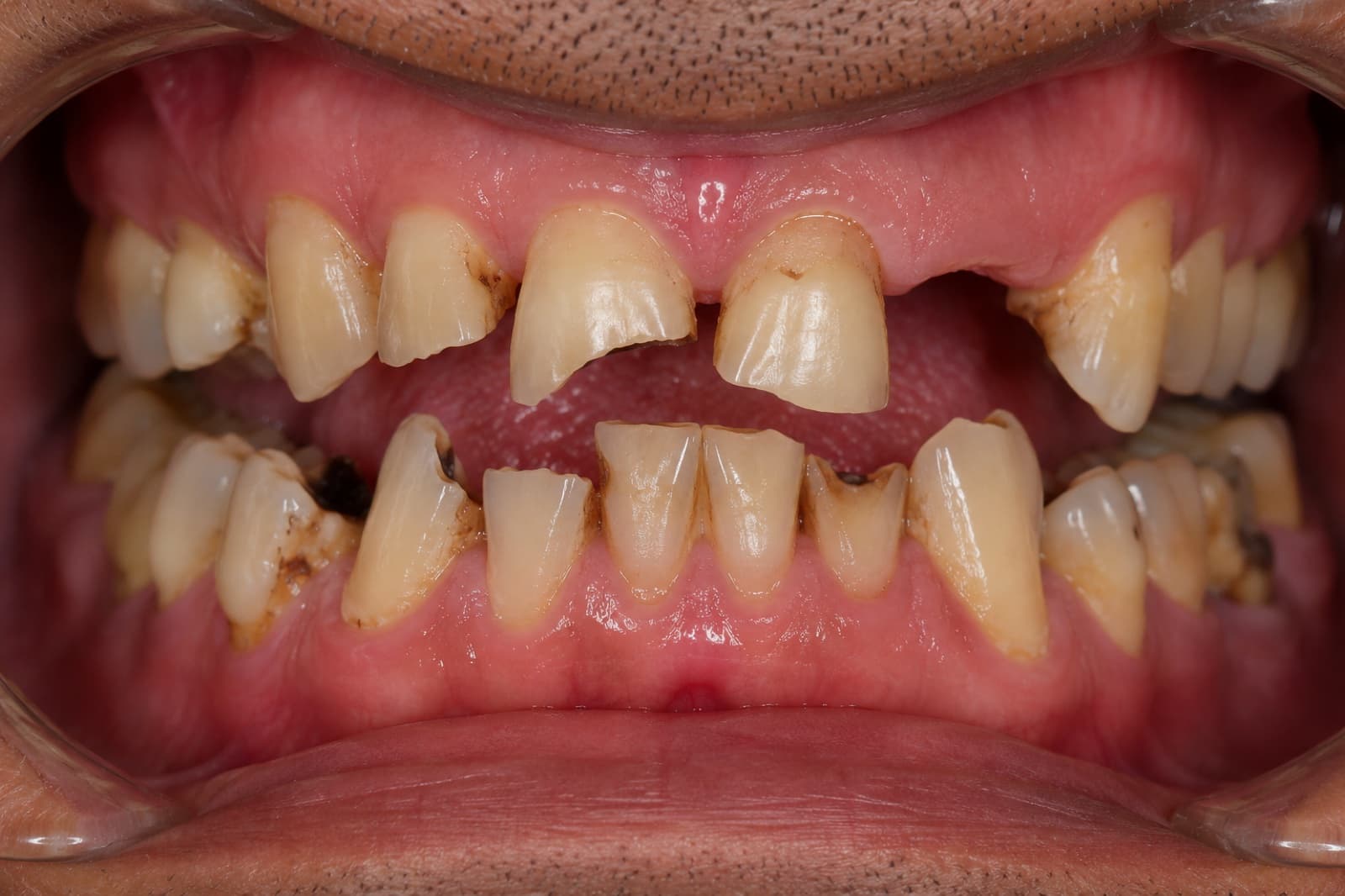 Worn, damaged smile before treatment by Dr. Trevor J. Thomas